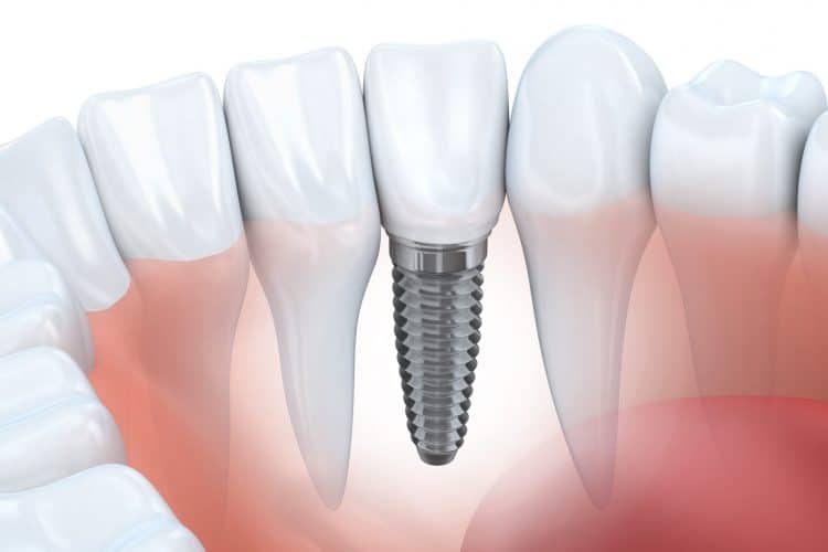Dental Implant Rendering