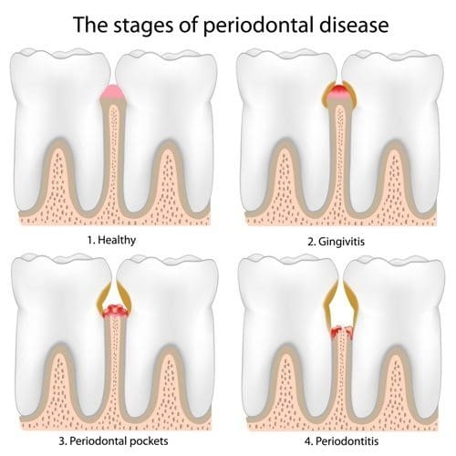 Stages of Periodontal Disease